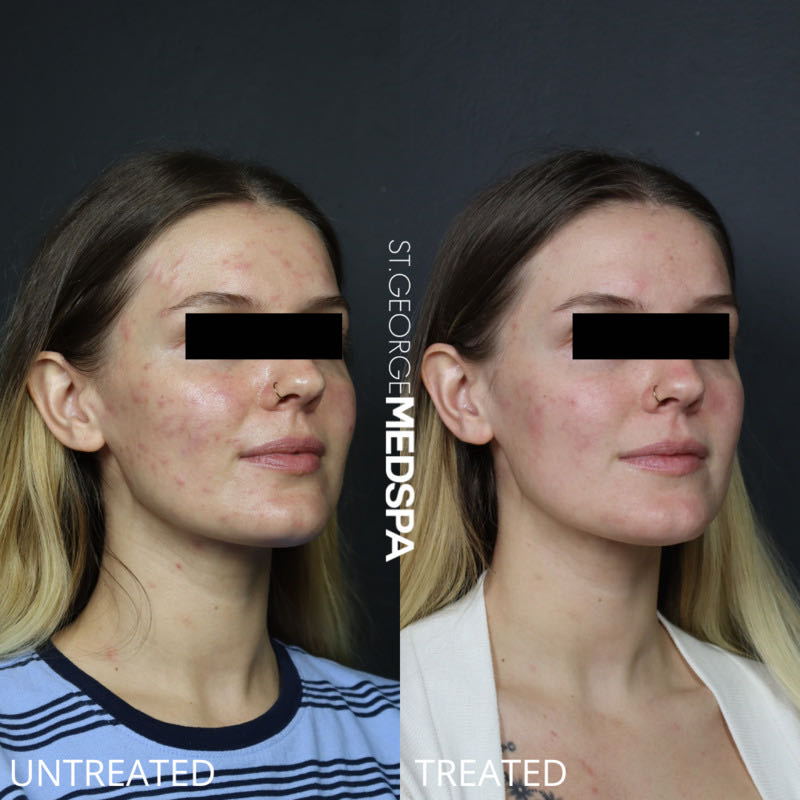 Chemical Peel Before & After Image