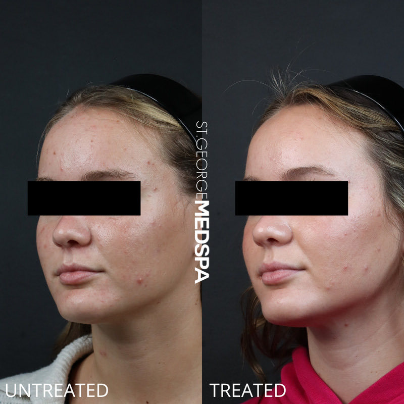Chemical Peel Before & After Image