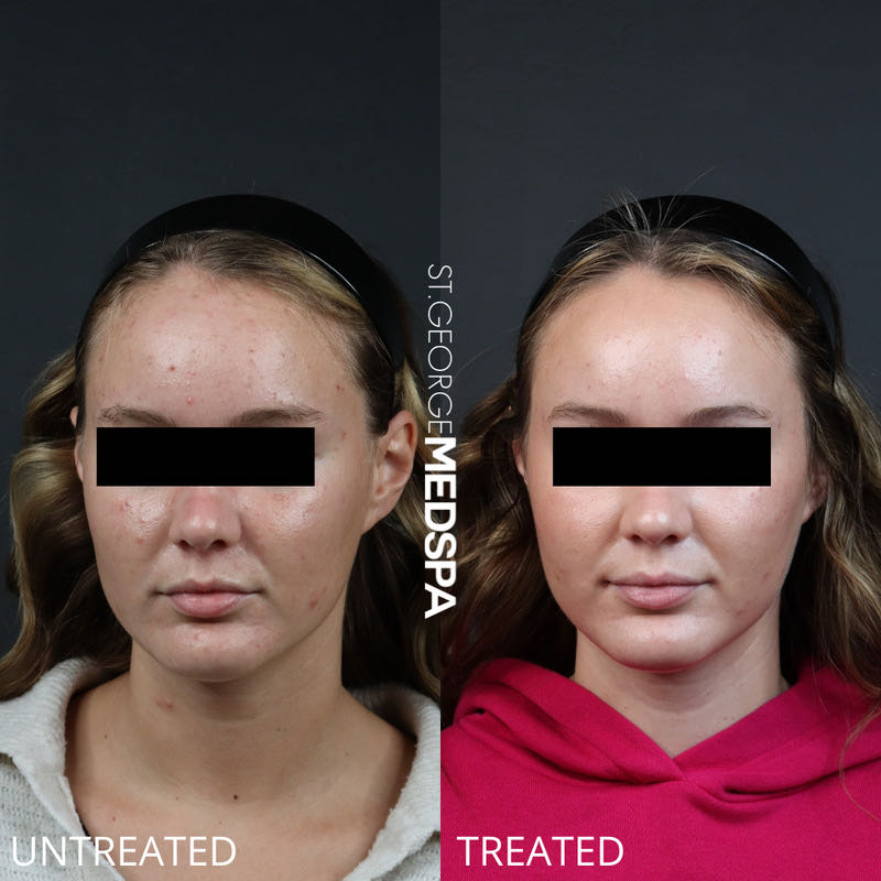 Chemical Peel Before & After Image
