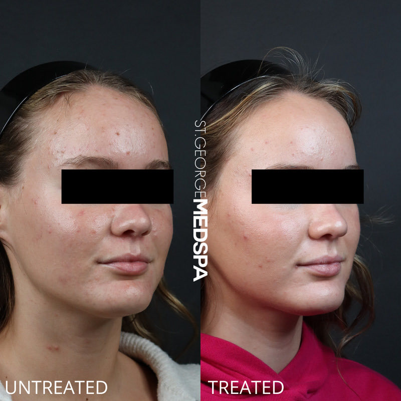 Chemical Peel Before & After Image