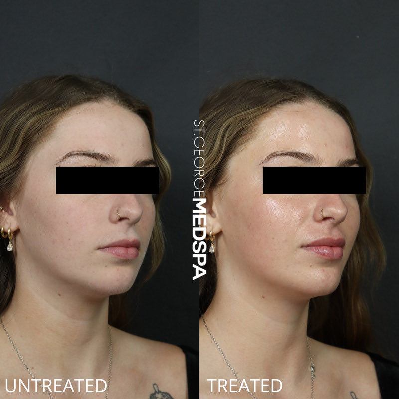 DiamondGlow Before & After Image
