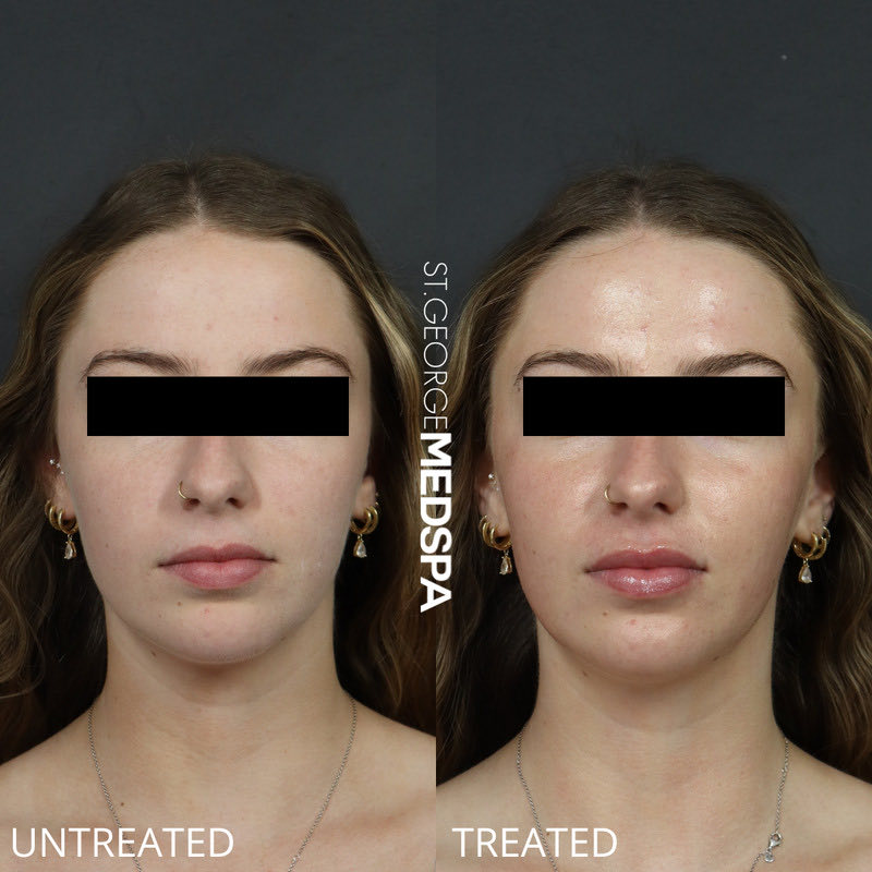 DiamondGlow Before & After Image
