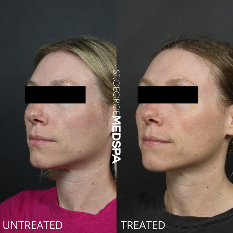 Microneedling Before & After Image