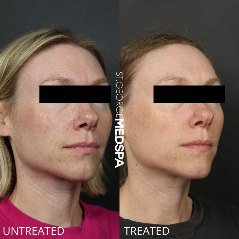Microneedling Before & After Image