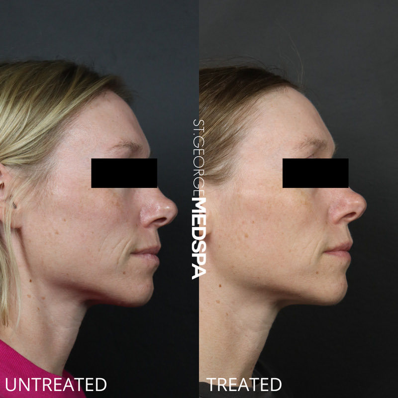 Microneedling Before & After Image