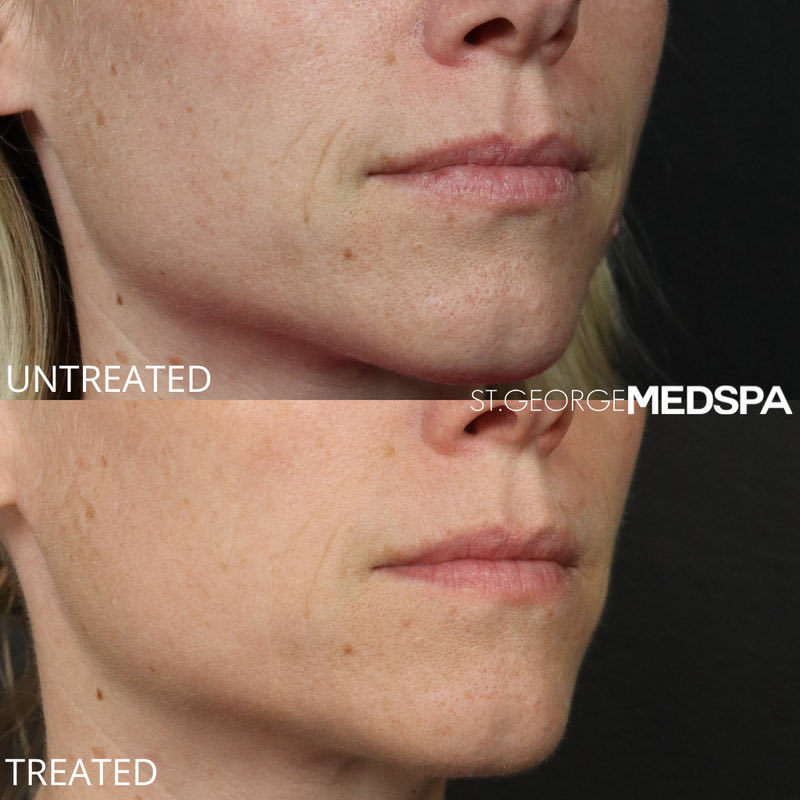 Microneedling Before & After Image
