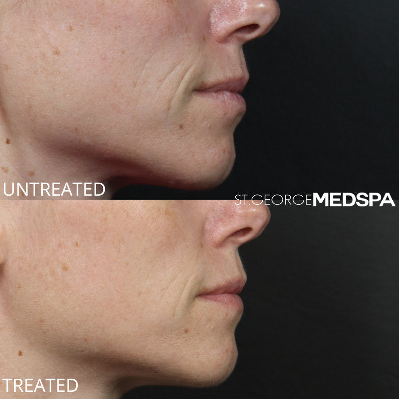 Microneedling Before & After Image