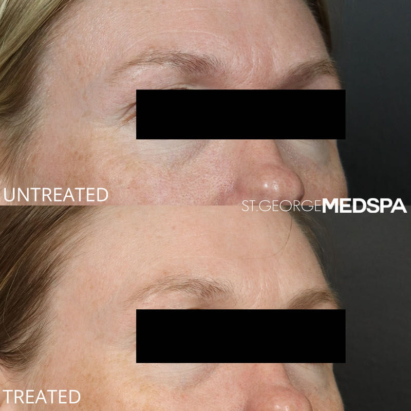 Microneedling Before & After Image
