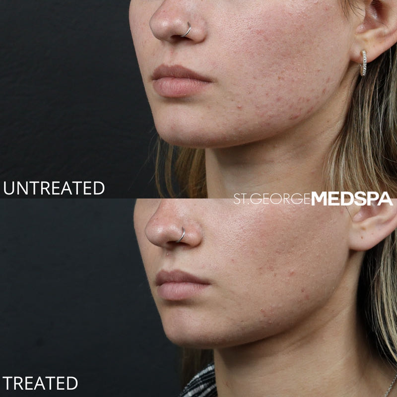 Microneedling Before & After Image