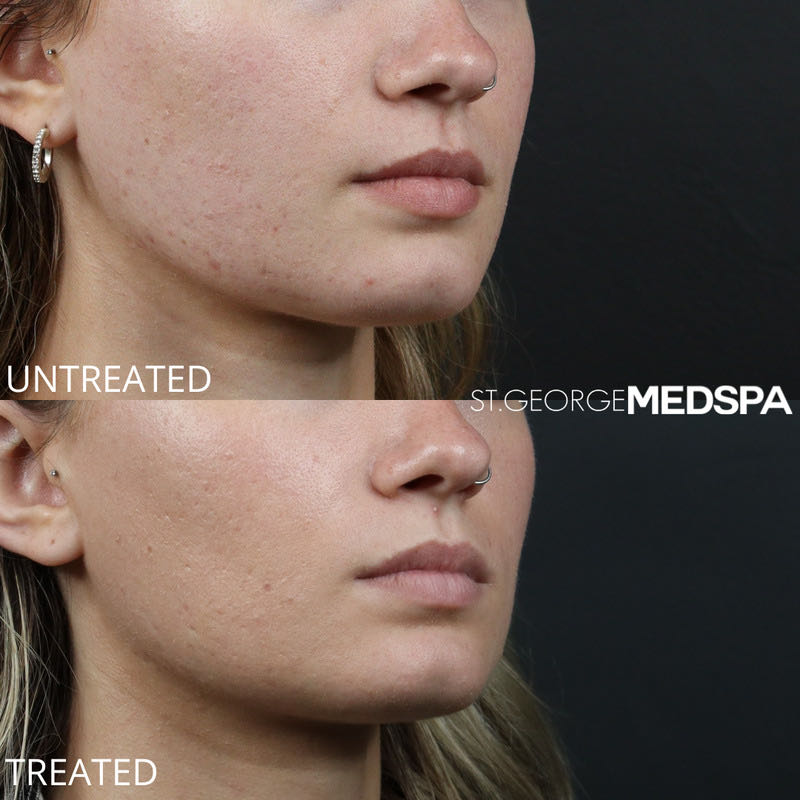 Microneedling Before & After Image
