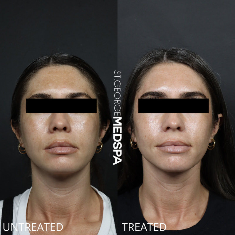 Microneedling Before & After Image