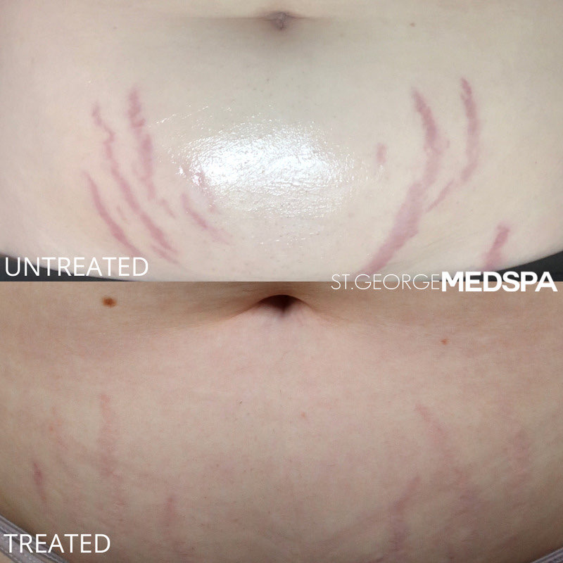Microneedling Before & After Image