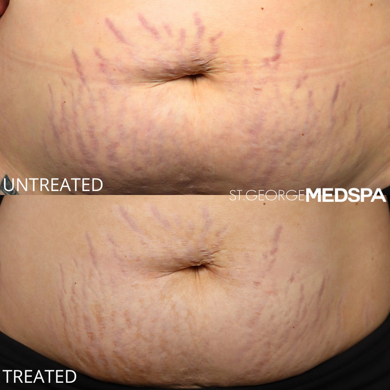 Microneedling Before & After Image