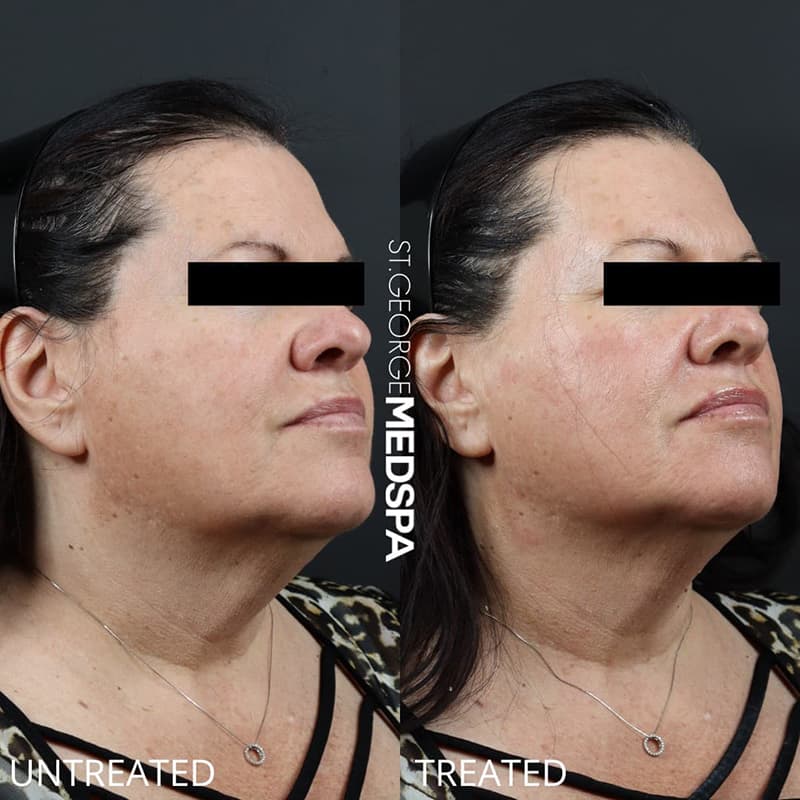 Skin Tightening Before & After Image