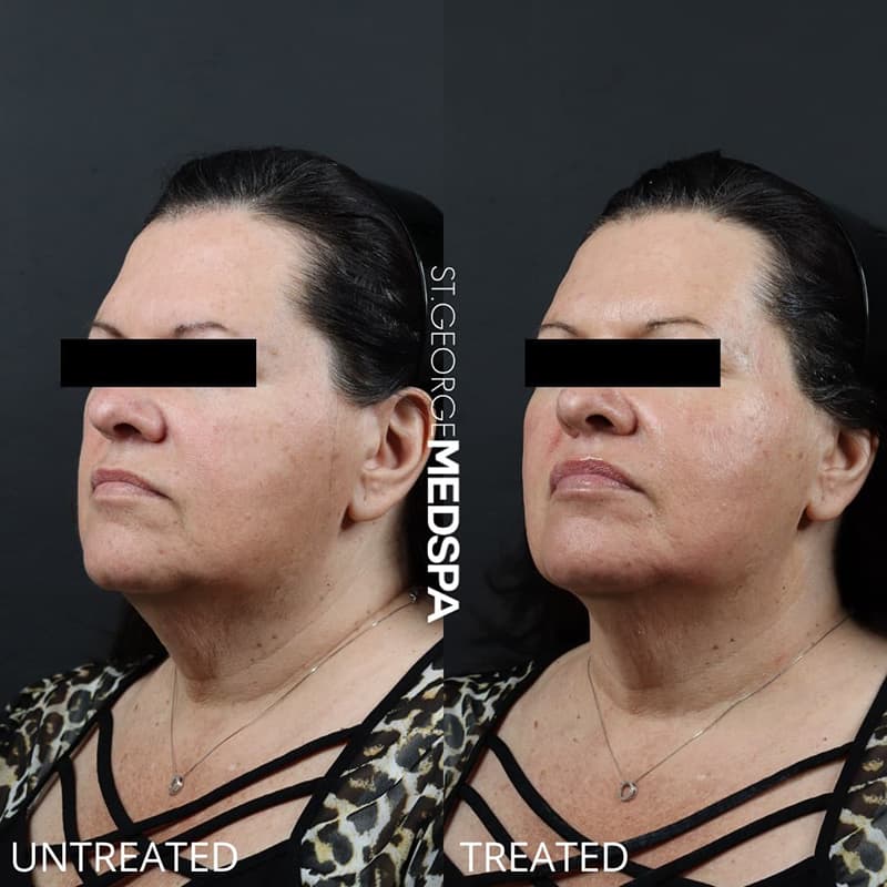 Skin Tightening Before & After Image