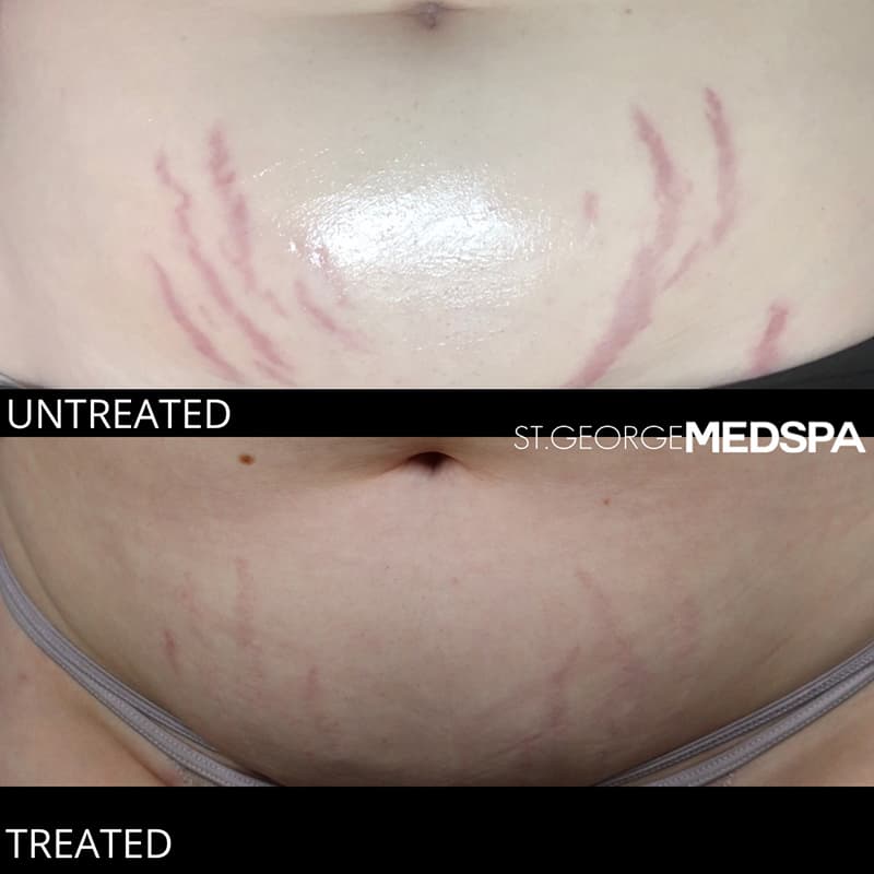 Skin Tightening Before & After Image