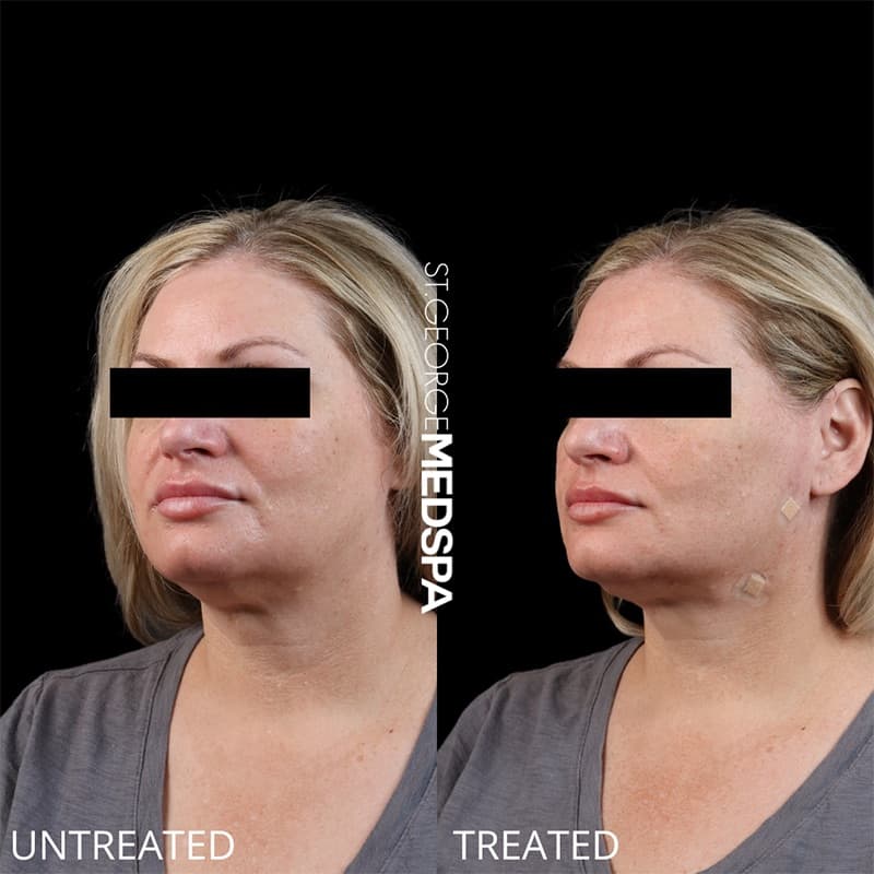 Skin Tightening Before & After Image