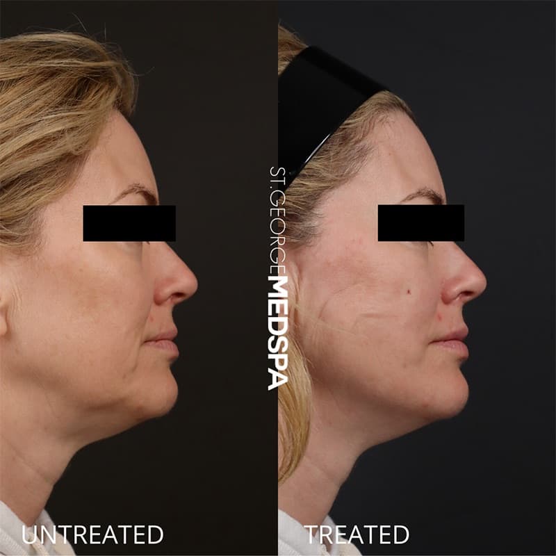 Skin Tightening Before & After Image