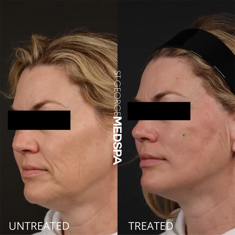 Skin Tightening Before & After Image