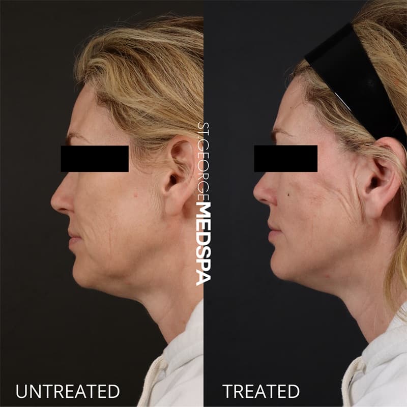 Skin Tightening Before & After Image