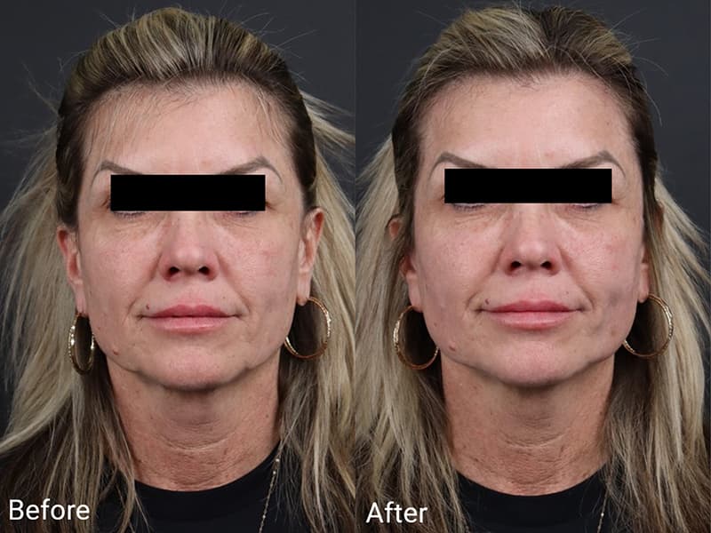 Skin Tightening Before & After Image