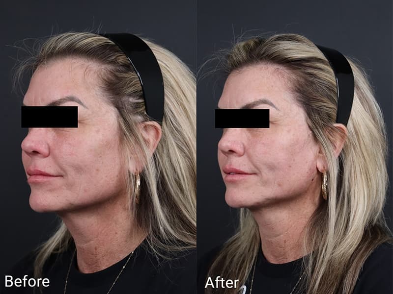 Skin Tightening Before & After Image